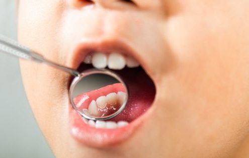 Qué es la caries, cómo se trata y la importancia de prevenirla