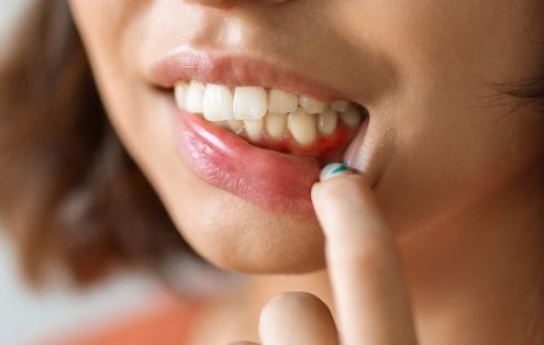 Gingivitis: cómo prevenir su aparición; consejos y tratamientos